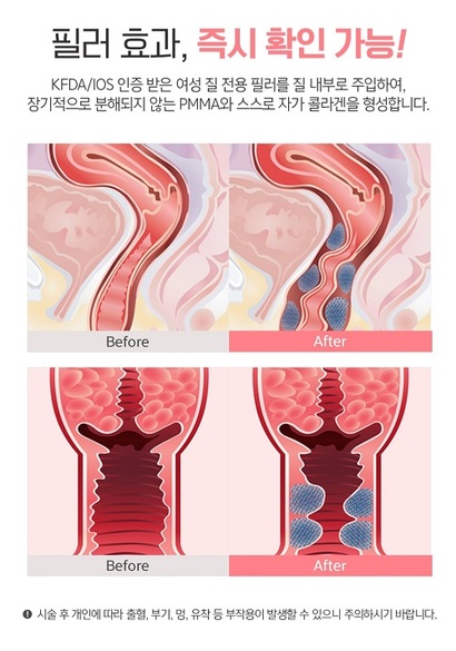 최근 20~30대 젊은 여성을 겨냥한 질 필러 시술 광고가 넘쳐나고 있다. 본래 ‘질 필러’​는 출산, 노화 등으로 늘어난 질을 좁혀주는 시술이다. 사진=성형 정보 앱 캡처