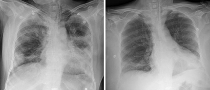 줄기세포 치료제와 함께 혈장 치료제도 주목받는다. 국내에서도 완치자 혈장을 투약한 코로나19 중증 환자 두 명이 완치하는 사례가 나왔다. 혈장 치료제 투약 전(왼쪽)과 후 환자의 폐를 찍은 엑스레이. 사진=최준용 세브란스병원 감염내과 교수 연구팀 논문 캡처