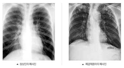 ​우리나라는 결핵 발병률이 경제협력개발기구(OECD) 회원국 가운데 1위라는 오명을 갖고 있다. 사진=대한결핵협회 홈페이지 캡처