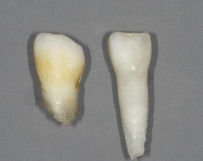 저인산효소증(HPP) 환아의 조기 탈락 유치(오른쪽)와 정상 유치 비교. 사진=논문 ‘저인산효소증의 치과적 양상 및 관리’ 오카와 레나·나카노 카즈히코